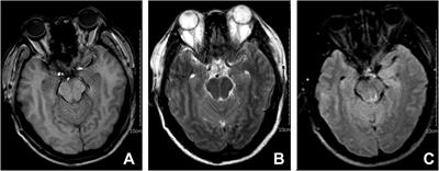 Autoimmune GFAP astrocytopathy after viral encephalitis: a case report of bimodal overlapping encephalitis